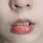 Home Remedy Fat Lip