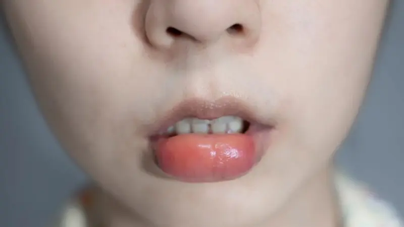 Home Remedy Fat Lip